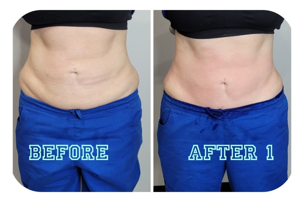 Exilis before and after